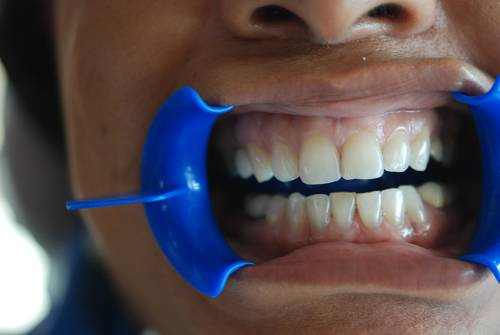 Dental Clinic Before Zoom Teeth Whitening Dental Clinic Before Zoom Teeth Whitening
