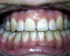 32 Smile Stone Braces used to correct crowded teeth