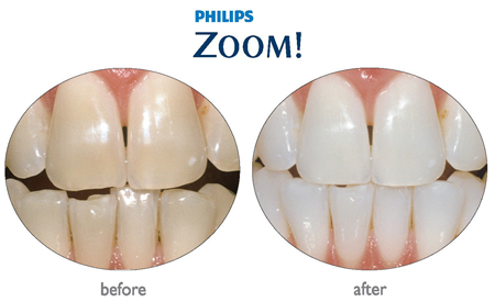 32 Smile Stone Teeth Whitening System 32 Smile Stone Teeth Whitening System