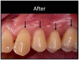 32 Smile Stone After Cosmetic Gum Treatment 32 Smile Stone After Cosmetic Gum Treatment