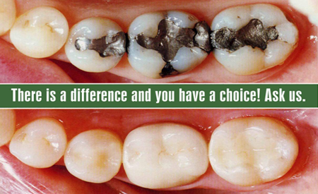 Composite dental fillings