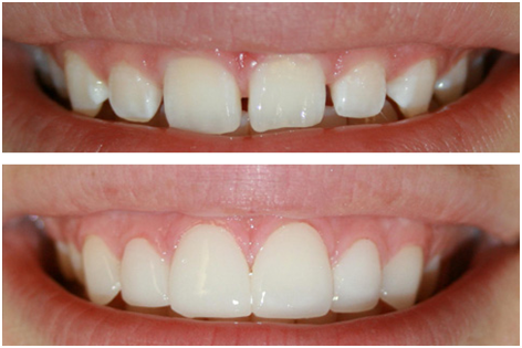 Ceramic Veneers treatment in new delhi