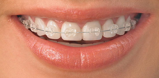 32 Smile Stone Ceramic Braces