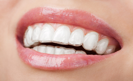 Aligners for clearance teeth cost