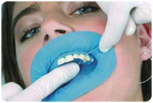 32 Smile Stone Dental Rubber Dam 32 Smile Stone Dental Rubber Dam