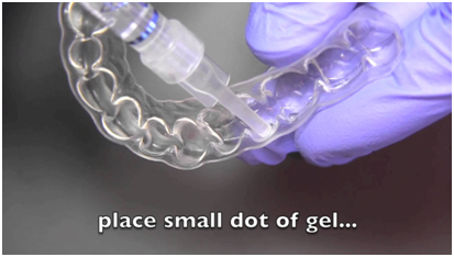 32 Smile Stone Home Bleaching Trays 32 Smile Stone Home Bleaching Trays