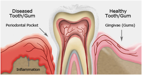 32 Smile Stone Dental Clinic delhi Scaling and Deep Cleaning