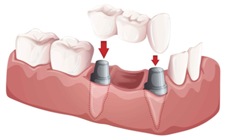 32 Smile Stone Dental Bridge