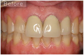 Dental Crowns